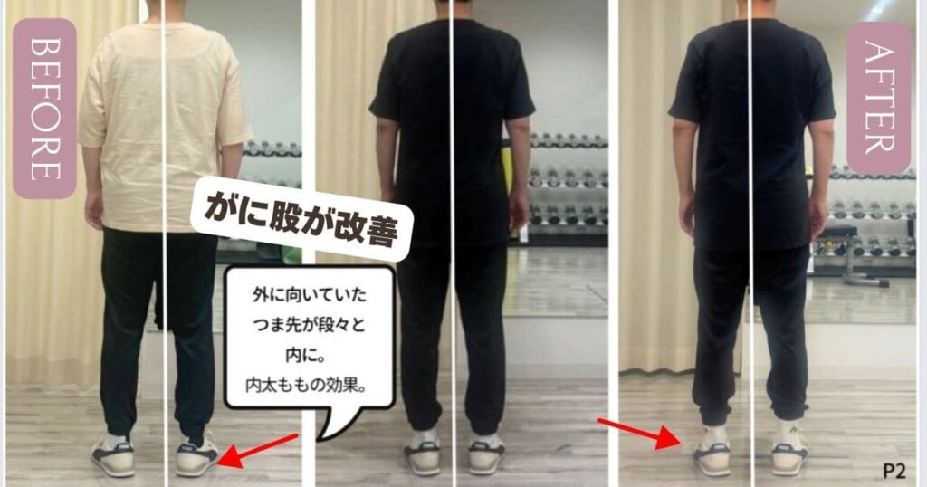 がに股が改善されています。